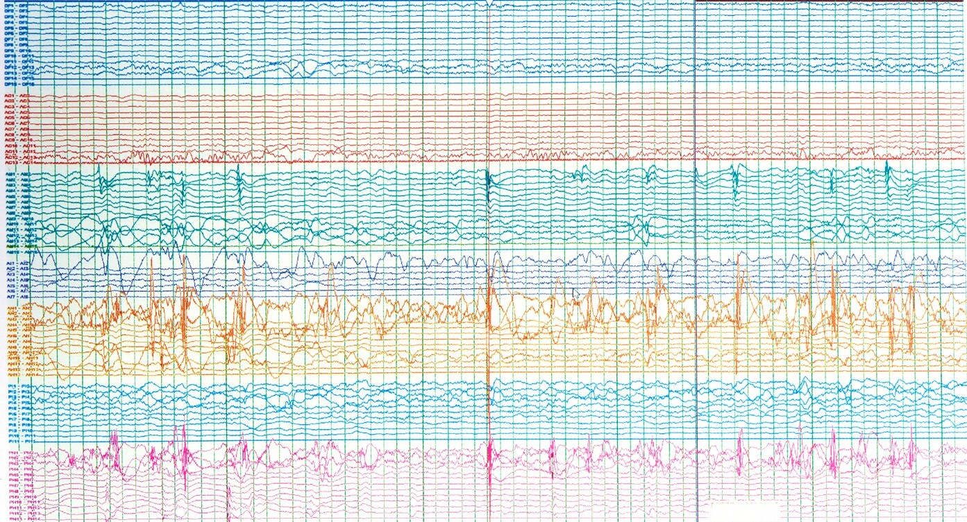 How Do Delta Sleep Inducing Peptides Work?